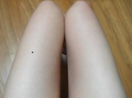 女生大腿内侧有痣代表什么