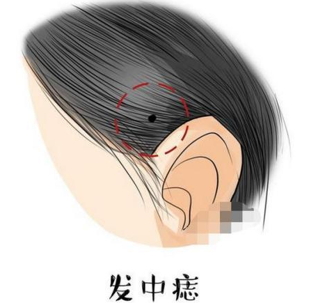 女人发中长痣代表什么