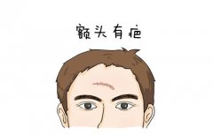 额头有疤痕是什么意思？